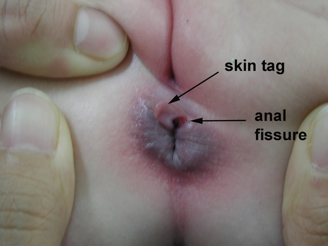 anal pics category anal fissure stomach diseases