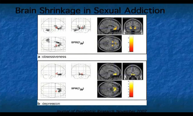 porn addiction porn sexual addiction any brain addicted evidence shrinkage