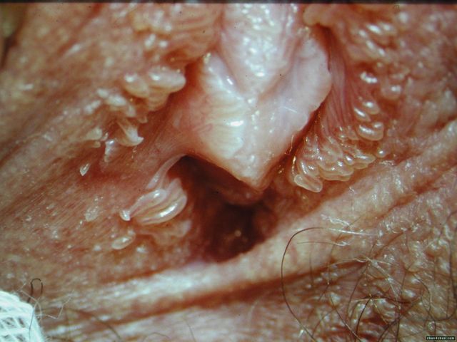 close up pic of a vagina gynecology