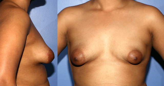 very small breasts photos category dark breast tuberous lipostructure