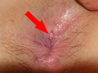 anal pics anal fissure fissures causes treatment