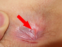 anal pics wikipedia commons anal fissure