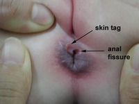 anal pics anal fissure category diseases stomach