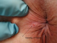 anal pics anal fistula