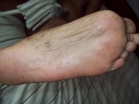 cum on feet pic experts dermatology foot