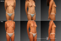 perky breasts pics photos mommymakeover redo tyqa weight loss after tah bso surgeons lake charles