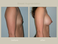 very small breasts photos procedures breast augmentation augmentations